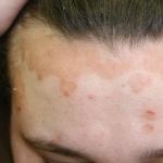 Симптоматика и лечение себорейной экземы на коже лица и головы Себорейная экзема лечение