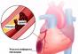Myocardial infarction: symptoms in men, first signs and consequences