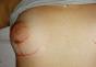 Razdoblje rehabilitacije nakon mamoplastike - preporuke liječnika i moguće negativne posljedice Bol u dojkama nakon mamoplastike.
