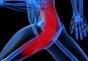 Ischiatický nerv nohy sa odčíta