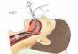 What are the consequences of general anesthesia for the body Problems after anesthesia