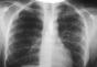 Gona focus in the lungs - what is a focal darkening syndrome Are metastases treated with folk remedies