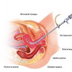 Komplikácie a následky hysteroskopie s kyretážou Rastie endometrium rýchlo po hysteroskopii?