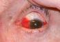 Complications after cataract surgery What is it and indications for use