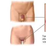 Komplexné liečebné režimy genitálneho herpesu (informácie pre odborníkov) Komplexná liečba genitálneho herpesu