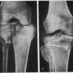 Recovery after a fracture of the condyle of the tibia