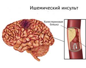 Ischemic cerebral stroke