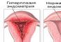 Secretos del tratamiento de la hiperplasia Remedios populares endometriales: recetas, revisiones que curaron la hiperplasia de endometrio por el Borovy Make