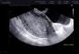 Pelvik organların ultrasonu nedir: ne zaman ve neden yapılmalı Ultrason yaptırmak ne zaman daha iyidir?