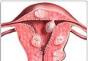 Čo je to maternicový myóm a ako sa lieči?