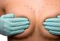 Fibroadenoma of the breast: what are the reasons for the appearance, remove or not?