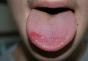 ¿Qué hacer si el niño se muerde la lengua con fuerza hasta la sangre?