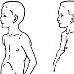 Un niño tiene una deformidad en el pecho: causas de patología y métodos de tratamiento.