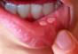Zapalenie jamy ustnej leczymy w domu