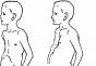 A child has a chest deformity: causes of pathology and treatment methods