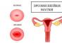 Secreción marrón antes de la menstruación: ¿qué significa y cómo tratarla?