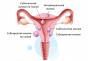 Vse o raku materničnega vratu 2. stopnje Maligni tumor materničnega vratu 2. stopnje