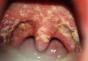 Placa blanca en las amígdalas sin fiebre: posibles causas y métodos de tratamiento La placa blanca en las amígdalas no daña la garganta