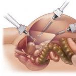 Laparoscopy (removal) of appendicitis Rules for removing appendicitis during laparoscopy