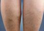 Venų varikozė ant kojų: simptomai su nuotraukomis ir gydymo metodais