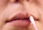 Liječenje herpesa na usnama Corvolol: razmatra kako se prijaviti