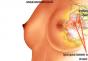Breast adenosis: what is it?