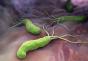 ტრიქოპოლუმი: გამოყენების ჩვენებები გინეკოლოგიაში შესაძლებელია თუ არა ტრიქოპოლუმის ტაბლეტების მიღება