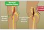 Upala ilijačnog mišića: simptomi i liječenje