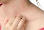 Reakcja alergiczna na ugryzienie komara • Jak leczyć alergie Dziecko ma na ciele pryszcze przypominające ugryzienia