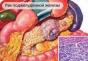 Karcinóm pankreasu - etiológia, patogenéza, klinický obraz