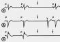 Vaizdo pamoka apie sinoatrialinę EKG blokadą (SA blokada)