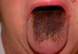 Razones de la aparición de placa marrón en la lengua.