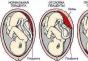 Placenta na robu notranje os
