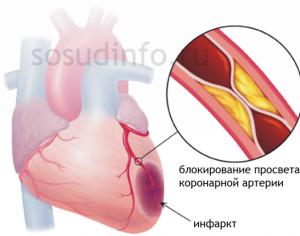 Infarto de miocardio: causas, primeros signos, ayuda, terapia, rehabilitación.