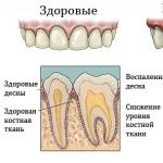 Pokretljivost zuba: stupnjevi, uzroci i liječenje Zahtjevi za iglene strukture