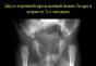 Vrodená dislokácia bedrového kĺbu: príčiny, príznaky a symptómy, diagnostika a liečba