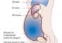Liječenje abdominalnog ascitesa u onkologiji narodni lijekovi Narodni lijekovi za liječenje tekućine u trbušnoj šupljini