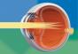 Astigmatism: what it is, causes, types, symptoms and treatment