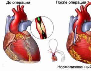 Spôsoby liečby infarktu myokardu